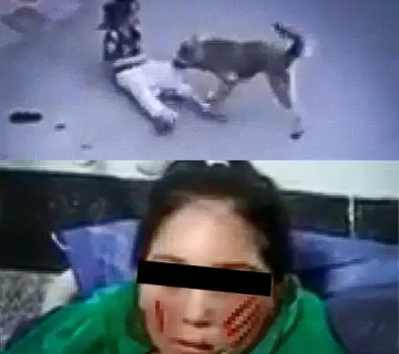 حمله سگ به دختر 8 ساله